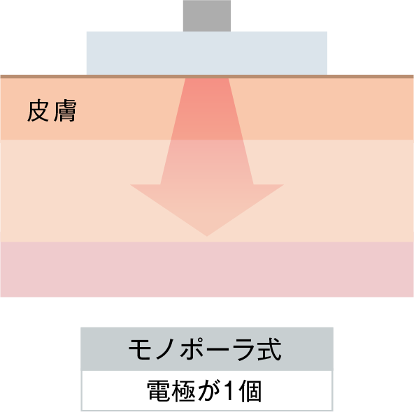 モノポーラ式 電極が1個